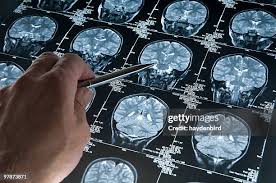 What Has Been the Best Approach to Early Prevention of Alzheimer's?